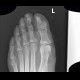 Acroosteolysis in diabetes mellitus, amputation in Chopart joint, gangrene: X-ray - Plain radiograph